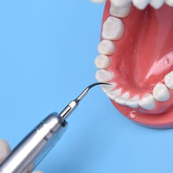Удаление зубного камня 