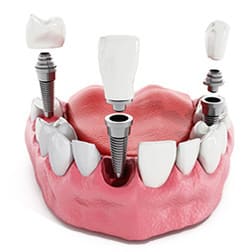 Импланты зубов в Самаре цена под ключ доступная