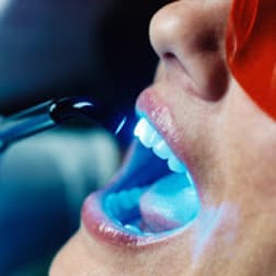 Лазерное отбеливание зубов