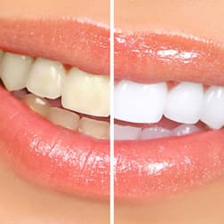 Чистка зубов ультразвуком