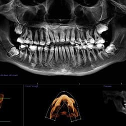 3D-Цефалометрия